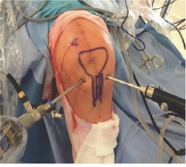 Arthroscopy Knee Surgery