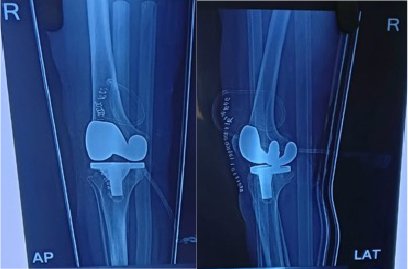 Cruciate Knee Replacement