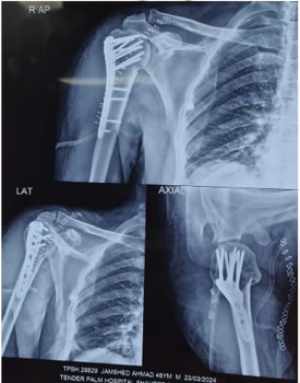 Trauma Shoulder Surgery