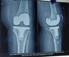 Posterior Stabilized Knee Replacement