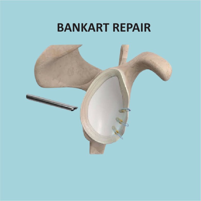 Surgery For Recurrent Dislocation of Shoulder
