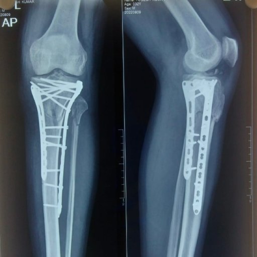 Trauma Knee Surgery