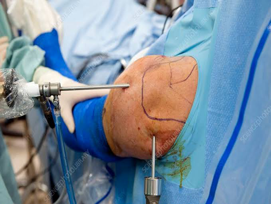 Arthroscopy-Shoulder-surgery