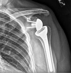 Shoulder Replacement(total/revers)