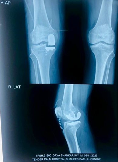 Unicompartment Knee Replacement