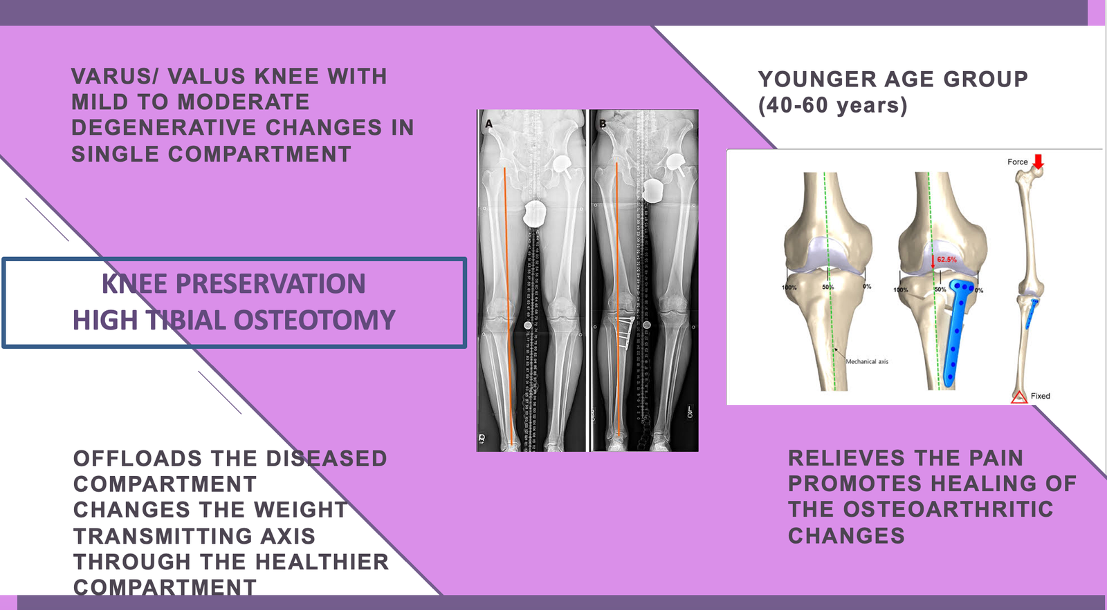 HIGH TIBIAL OSTEOTOMY